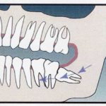 Wisdom Teeth Cause Crowding