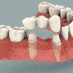dental implants Chicago