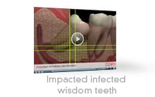 Impacted, Infected Wisdom Teeth video