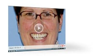 AvaDent-On-Four Upper Prosthesis video