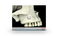 Bone Atrophy Upper Maxilla video