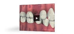 Why Replace a Missing Tooth (English) Video