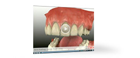 Ridge Preservation Bone Graft Tooth Socket Video