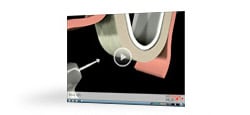 Sinus Lift - Lateral video
