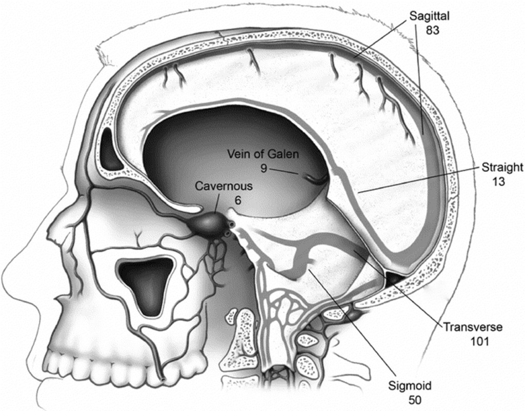 Dangers of a tooth abscess Part 4: Cavernous Sinus Thrombosis