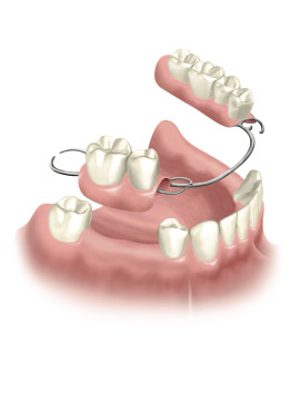 2-IB dental bridge
