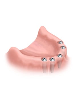 3-DR implants