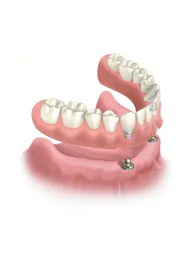 3-DS implants