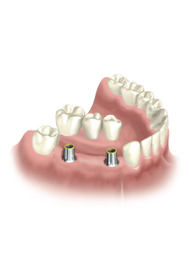 3-IB bridge implant