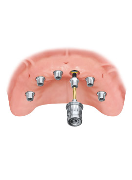 4-DR implant
