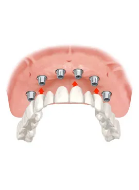 5-DR full upper arch implants