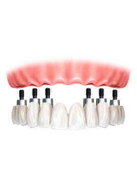 7-DR multiple teeth replacement