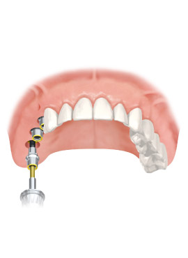7-IB implant