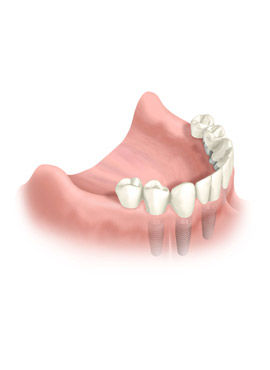 9-DR teeth replacement