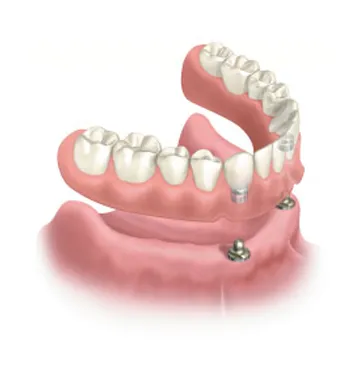 Service implant dentures