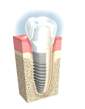 specialty-dentalimplants