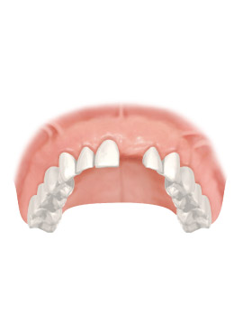 missing tooth