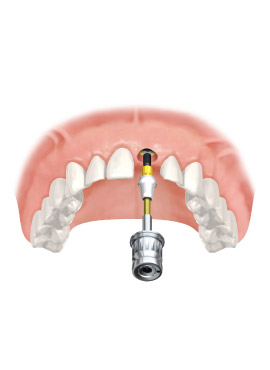 Dental implants