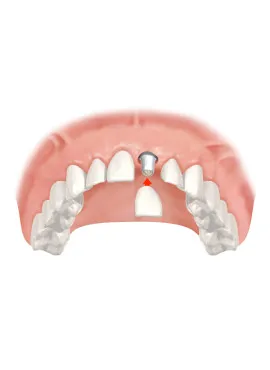 Dental crown