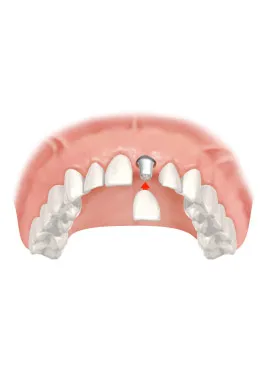 4 crown tooth replacement