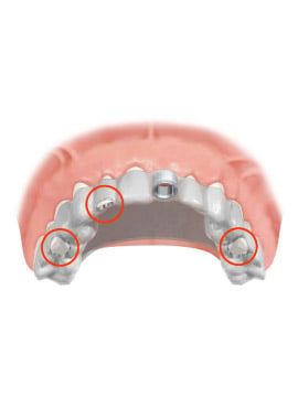 Implant teeth