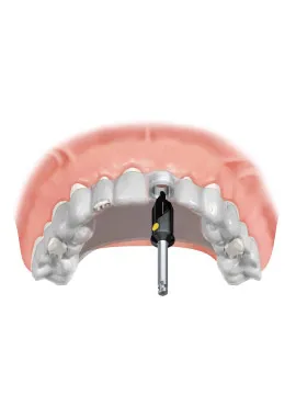 7 implant procedure