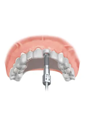 8 implant abutment