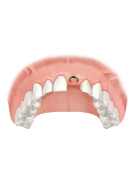 9 implant
